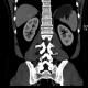 Nephrolithiasis: CT - Computed tomography
